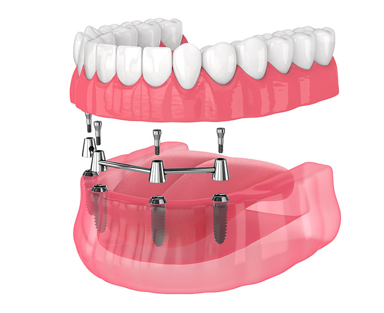 What Are All-on-4 Dental Implants See Me Smile Dental in Oxnard CA