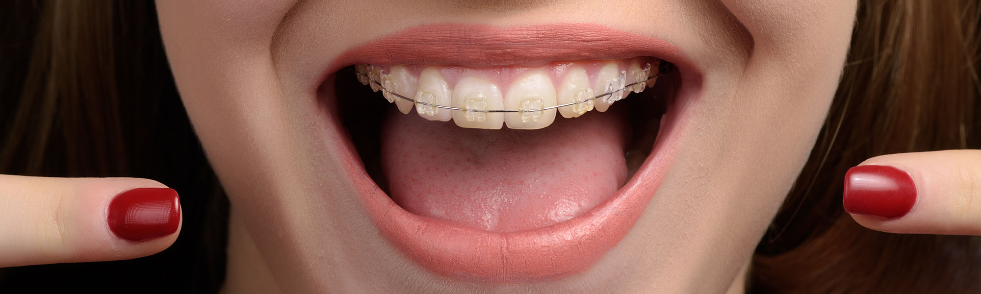 Porcelain Ceramic Braces See Me Smile Dental Oxnard CA