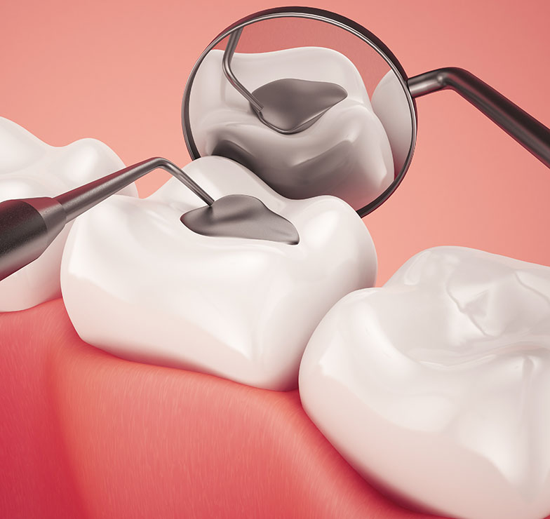 What Are Composite Fillings See Me Smile Dental Oxnard CA Image