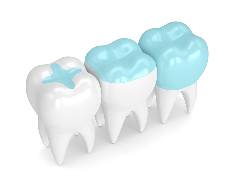 Porcelain Inlays & Onlays at See Me Smile Dental Oxnard CA