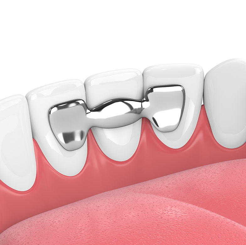 What Are Fixed Dental Bridges See Me Smile Dental Oxnard CA Image.