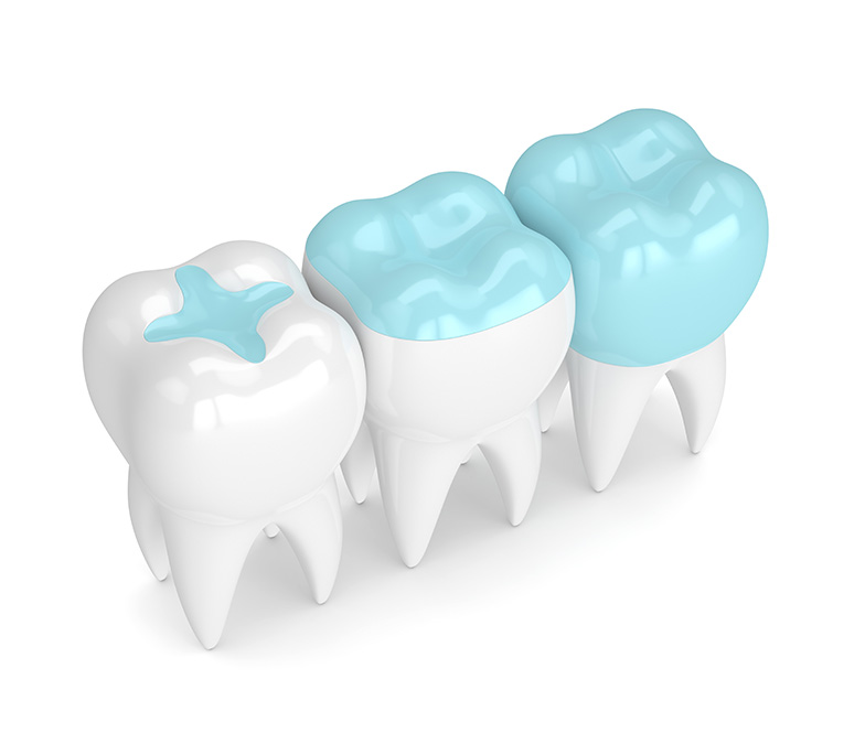 What Is the Difference Between Dental Inlays and Onlays See Me Smile Dental Oxnard CA Image.