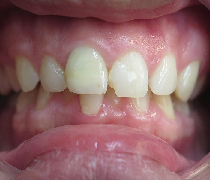 Before composite tooth-colored fillings – Oxnard, CA patient