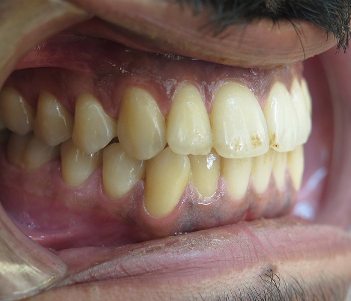 Before deep teeth cleaning and polishing – Oxnard, CA patient