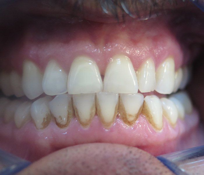 Before dental cleaning with discoloration – Oxnard, CA patient