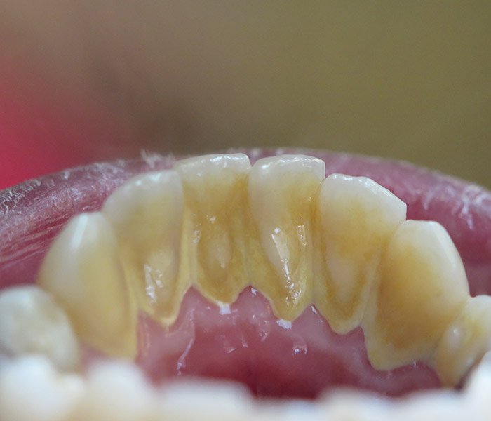 Before teeth cleaning showing plaque and tartar – Oxnard, CA patient