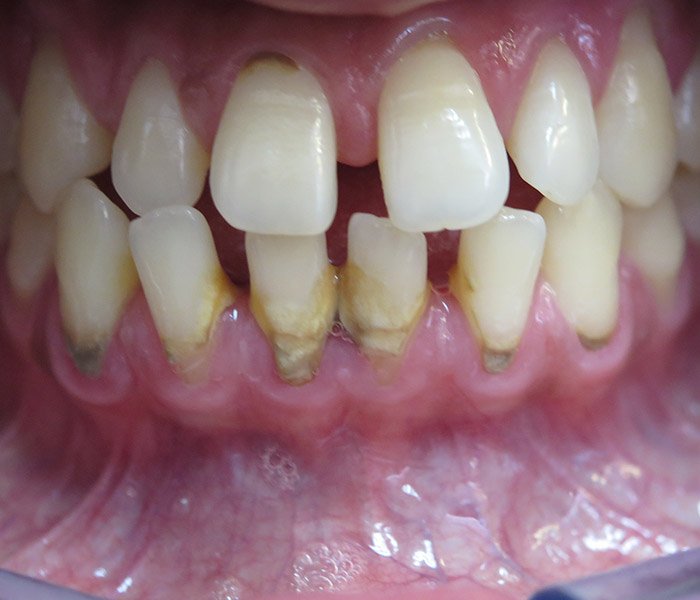 Before professional teeth cleaning with staining – Oxnard, CA patient