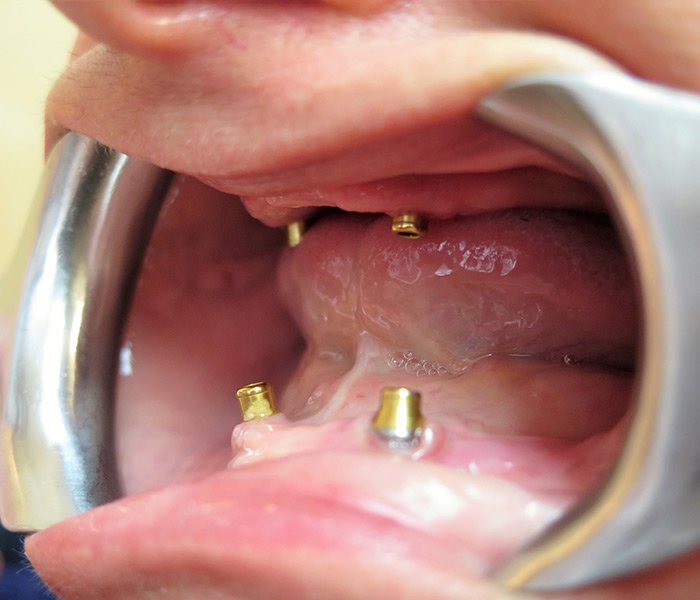 Before All-on-4 implant treatment – Oxnard, CA patient