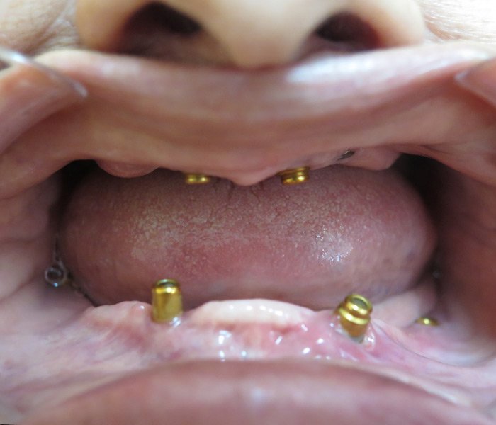 Before full mouth All-on-4 restoration – Oxnard, CA patient