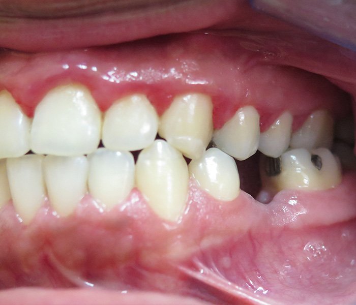 Before multiple dental implants restoration – Oxnard, CA patient