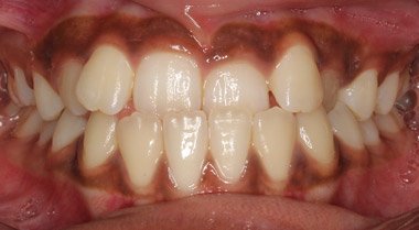 Before orthodontic treatment with misaligned teeth – Oxnard, CA patient