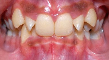 Before braces and bite correction – Oxnard, CA patient
