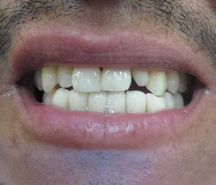Before veneers for chipped and discolored teeth – Oxnard, CA patient