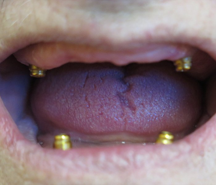 Before All-on-4 dental implants smile – Oxnard, CA patient