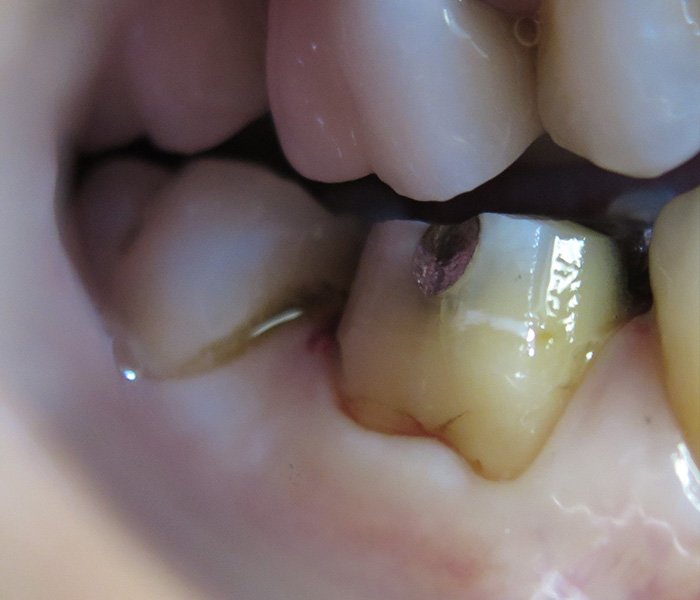 Before dental crown treatment on front teeth – Oxnard, CA patient