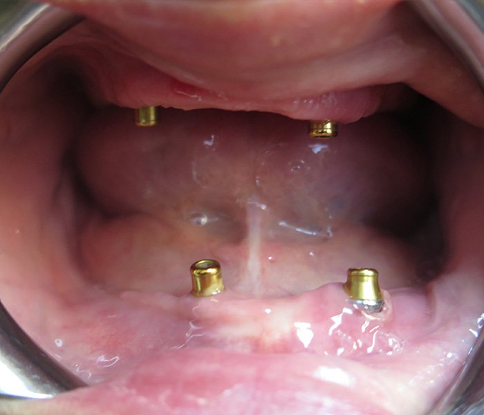 Before All-on-4 full arch restoration – Oxnard, CA patient