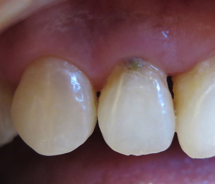 Before replacement of metal fillings with composite – Oxnard, CA patient