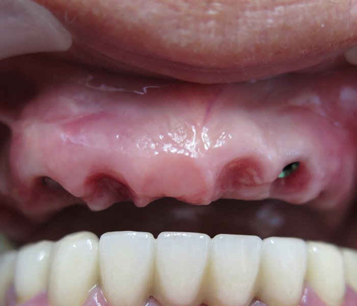 Before full arch implant-supported teeth – Oxnard, CA patient