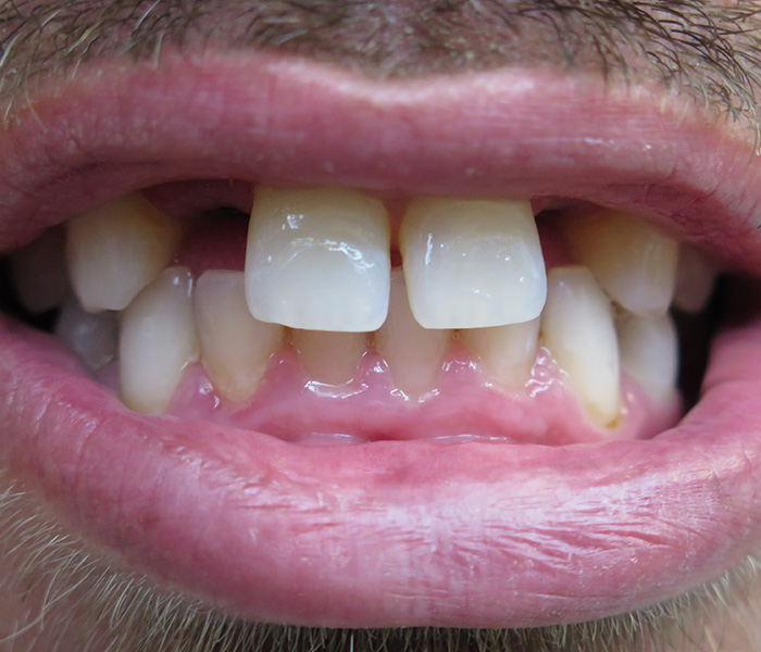 Before dental implant bridge restoration – Oxnard, CA patient
