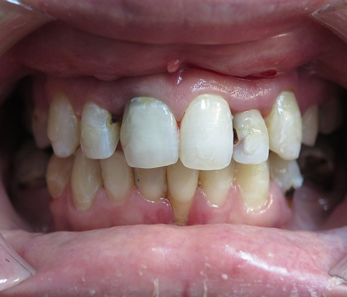 Before single tooth dental implant – Oxnard, CA patient