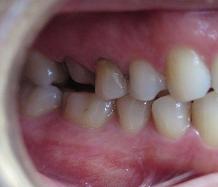 Before cosmetic dental crowns smile makeover – Oxnard, CA patient