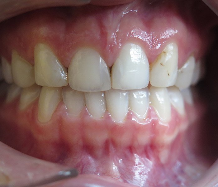 Before porcelain veneers cosmetic makeover – Oxnard, CA patient