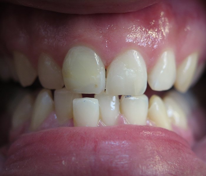 After composite tooth-colored fillings – Oxnard, CA patient