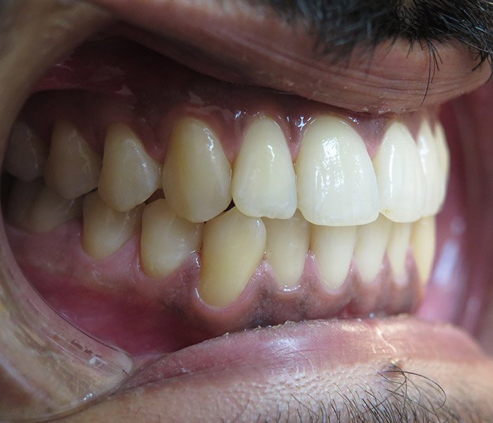 After deep teeth cleaning and polishing – Oxnard, CA patient