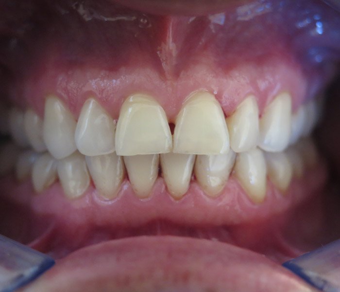 After dental cleaning with healthier, cleaner teeth – Oxnard, CA patient