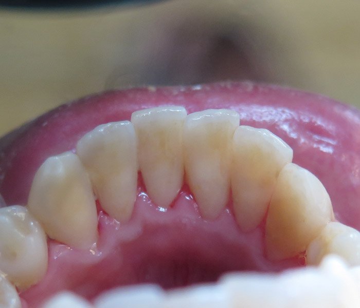 After teeth cleaning with brighter smile – Oxnard, CA patient