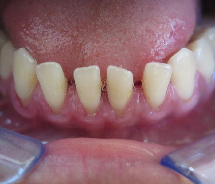 After professional teeth cleaning with stain removal – Oxnard, CA patient