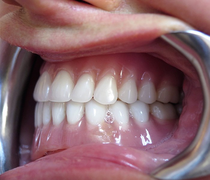 After All-on-4 implant treatment – Oxnard, CA patient
