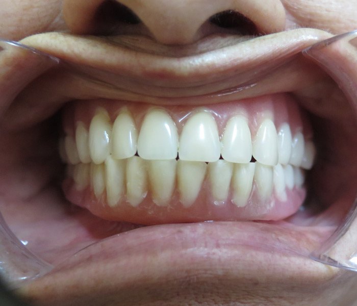 After full mouth All-on-4 restoration – Oxnard, CA patient