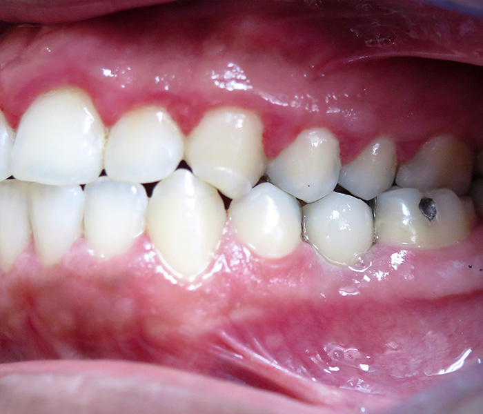After multiple dental implants restoration – Oxnard, CA patient
