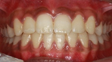 After orthodontic treatment with straightened teeth – Oxnard, CA patient