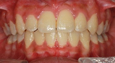 After braces and bite correction – Oxnard, CA patient