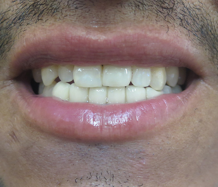 After veneers for chipped and discolored teeth – Oxnard, CA patient