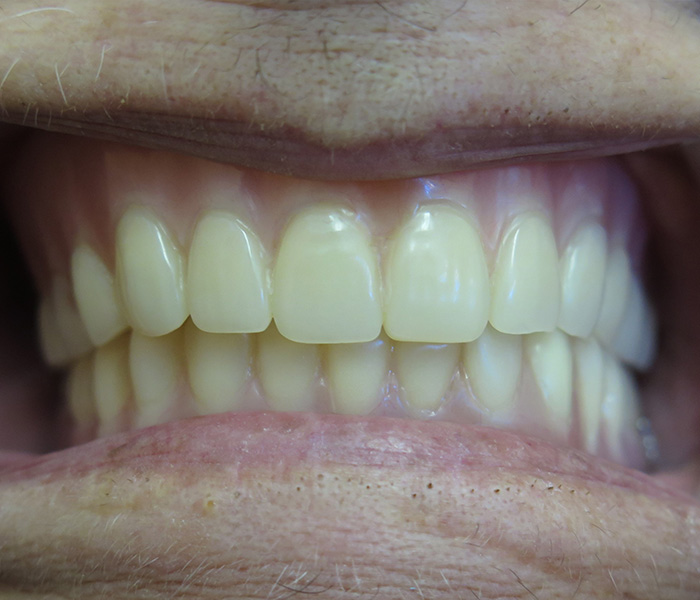 After All-on-4 dental implants smile – Oxnard, CA patient