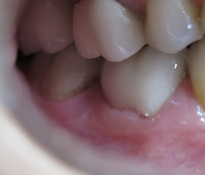 After dental crown treatment on front teeth – Oxnard, CA patient
