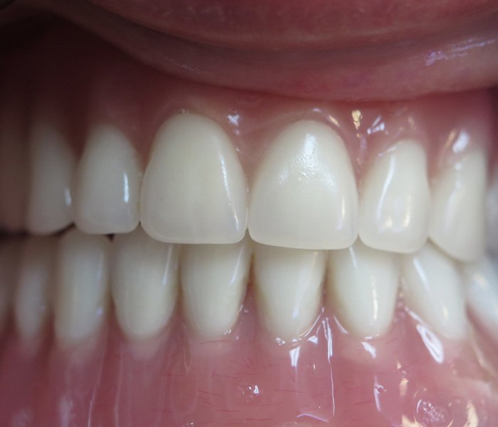 After All-on-4 full arch restoration – Oxnard, CA patient