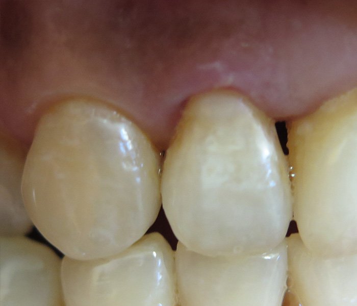 After replacement of metal fillings with composite – Oxnard, CA patient