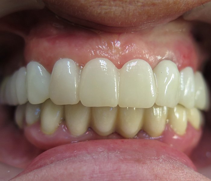 After full arch implant-supported teeth – Oxnard, CA patient