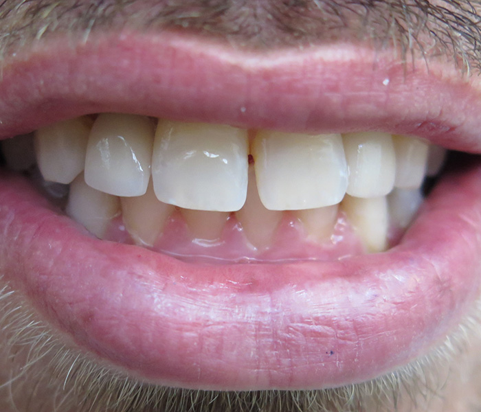 After dental implant bridge restoration – Oxnard, CA patient