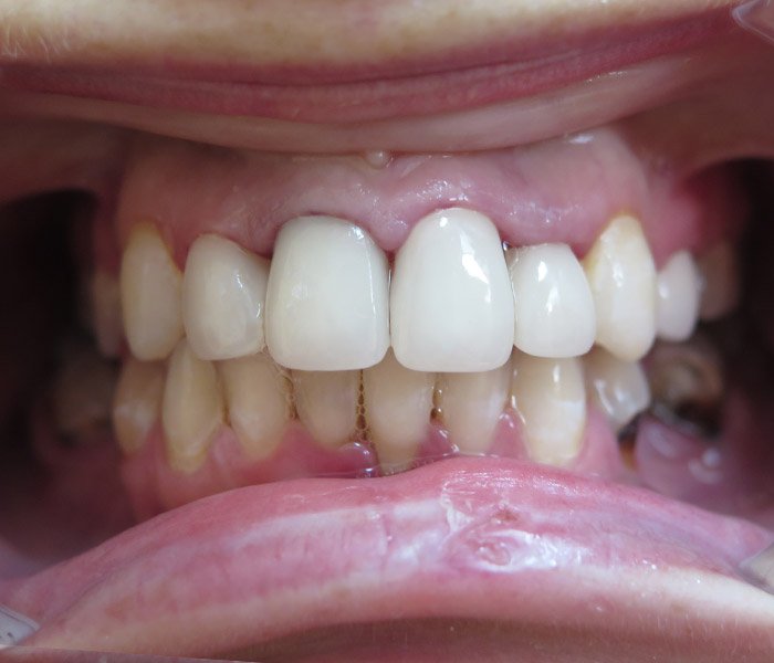 After single tooth dental implant – Oxnard, CA patient