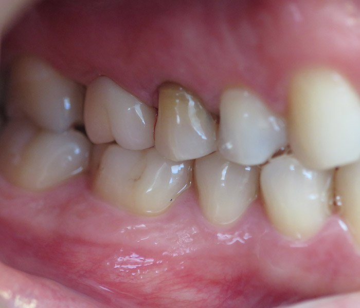 After cosmetic dental crowns smile makeover – Oxnard, CA patient