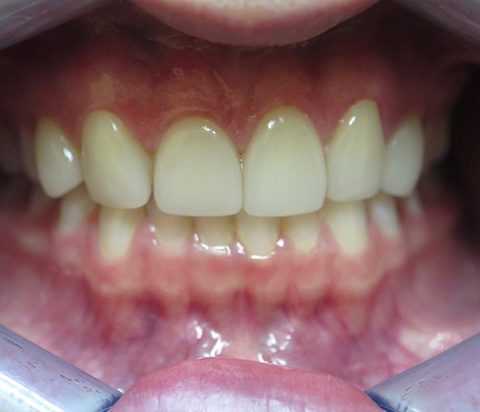 After porcelain veneers cosmetic makeover – Oxnard, CA patient