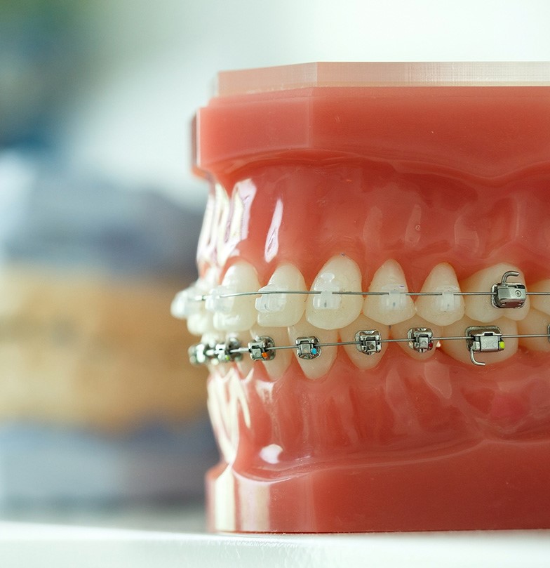Are Porcelain Ceramic Braces Better Than Traditional Metal Braces See Me Smile Dental Oxnard CA