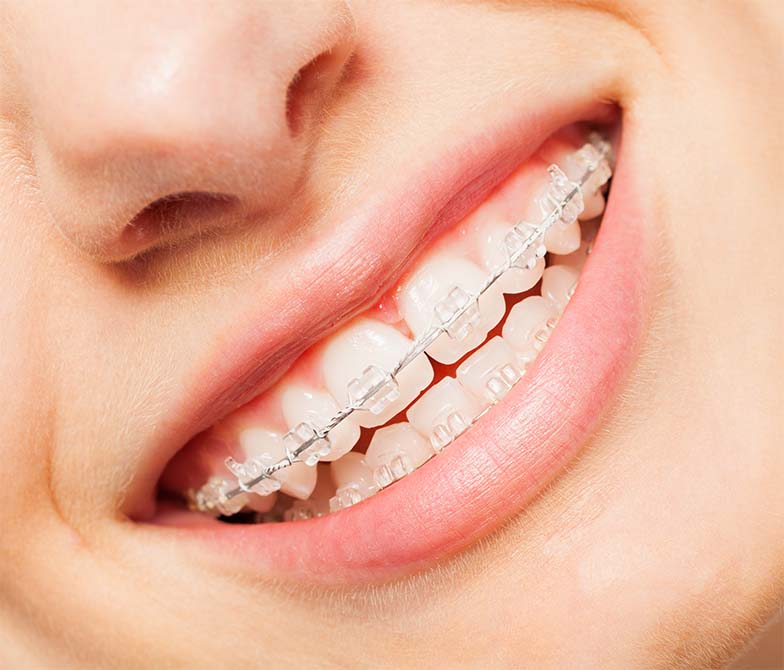 Are Porcelain Ceramic Braces Durable See Me Smile Dental Oxnard CA Image.