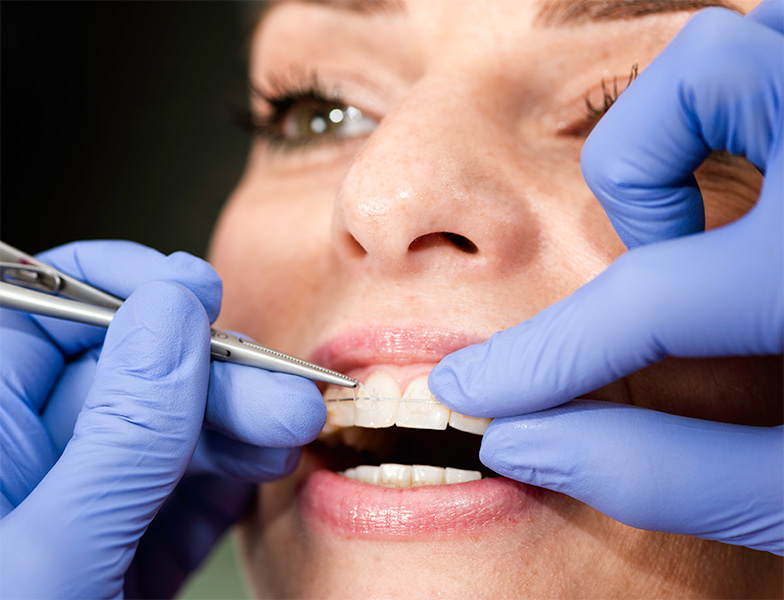 How Do I Get Porcelain Ceramic Braces See Me Smile Dental Oxnard CA