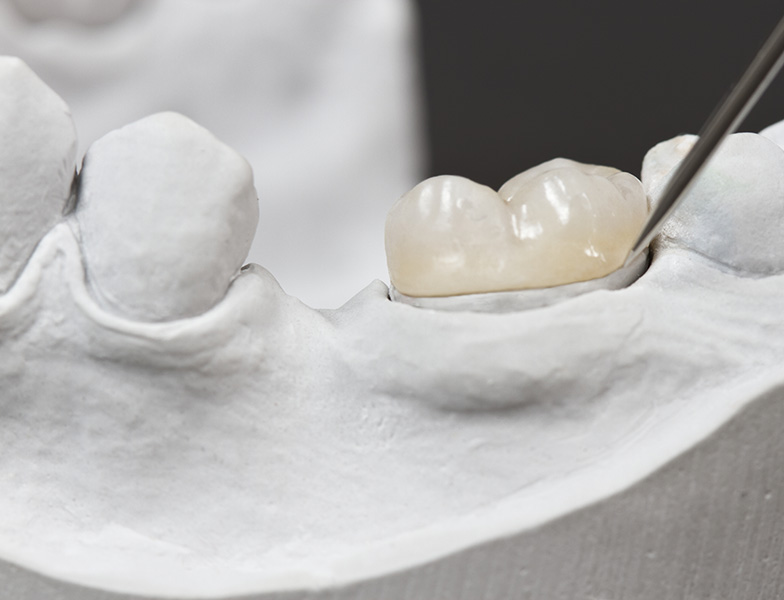 Porcelain-Fused-to-Metal Dental Crowns See Me Smile Dental Oxnard CA